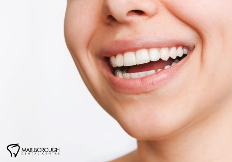 Caring For Your Veneers: Maintenance And Hygiene Tips